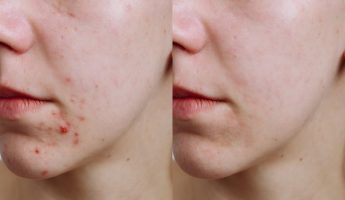 Young woman before and after acne treatment, closeup. Skin care concept Young woman before and after acne treatment, closeup. Skin care concept.